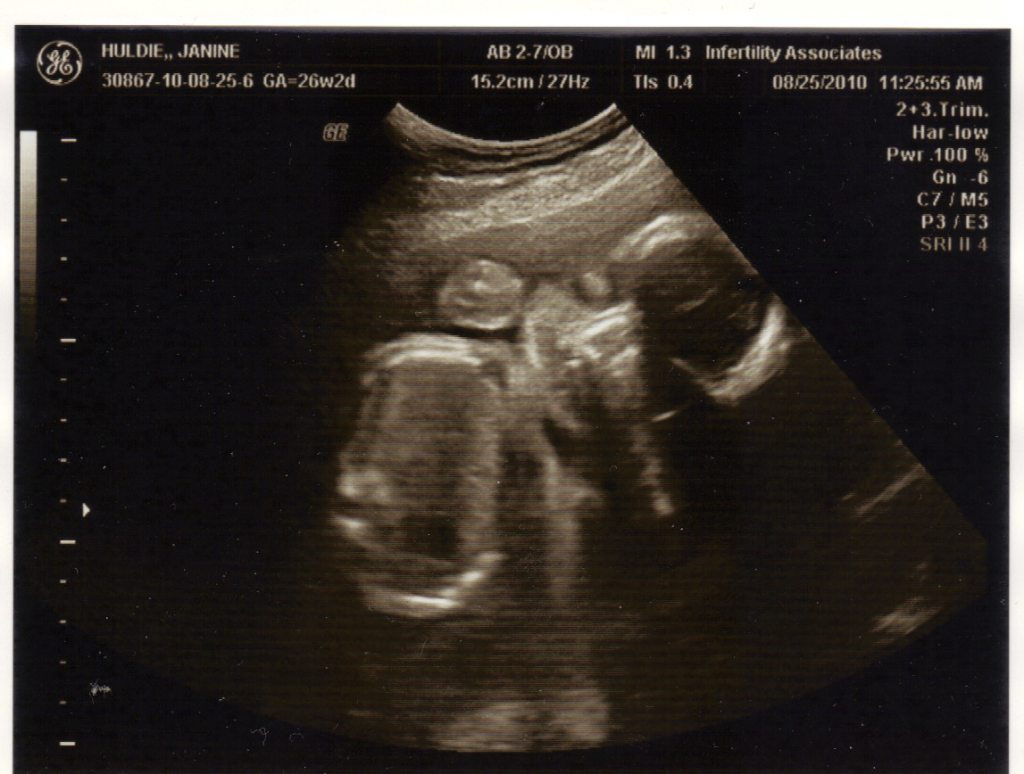 Ultrasound of Lily