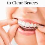 A Step-By-Step Guide to Clear Braces